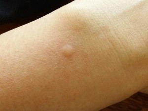 蚊の吸血痕